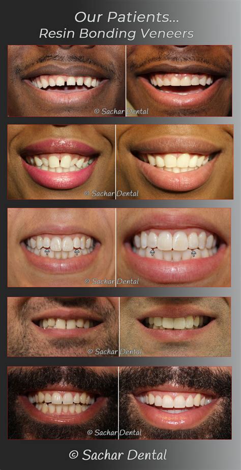 resin veneers before and after.